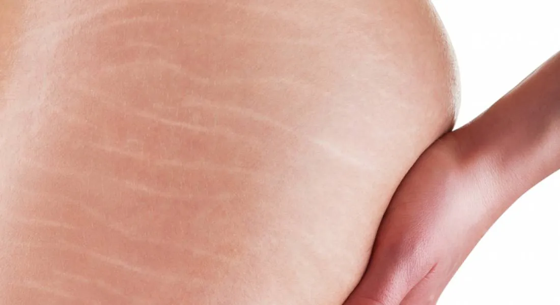 Come Togliere le Smagliature Bianche sul Sedere