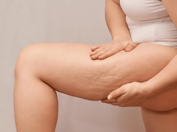 Coscia femminile con presenza di cellulite e lieve rilassamento cutaneo mentre la persona solleva la pelle per evidenziarne l’aspetto.