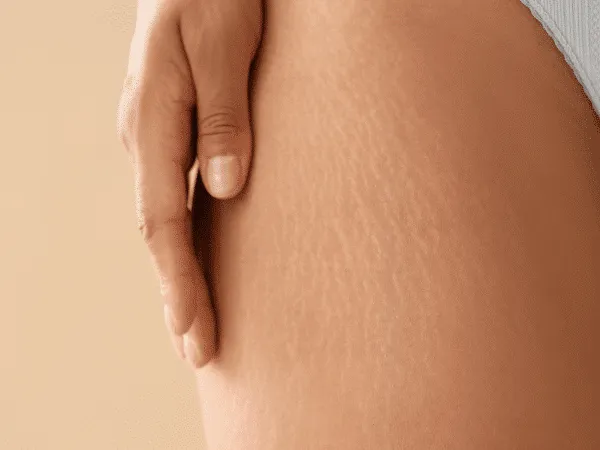Smagliature chiare sulla pelle della coscia femminile viste da vicino.