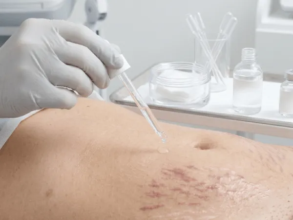 Applicazione acido ialuronico dopo peeling chimico