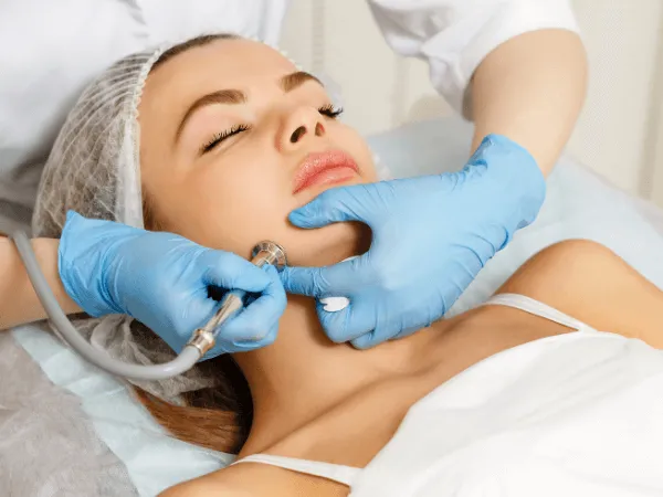 Dermoabrasione viso eseguita da medico con strumento rotante per il trattamento di cicatrici e imperfezioni cutanee