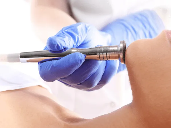 Strumento professionale per dermoabrasione utilizzato sul viso per levigare la pelle e ridurre cicatrici