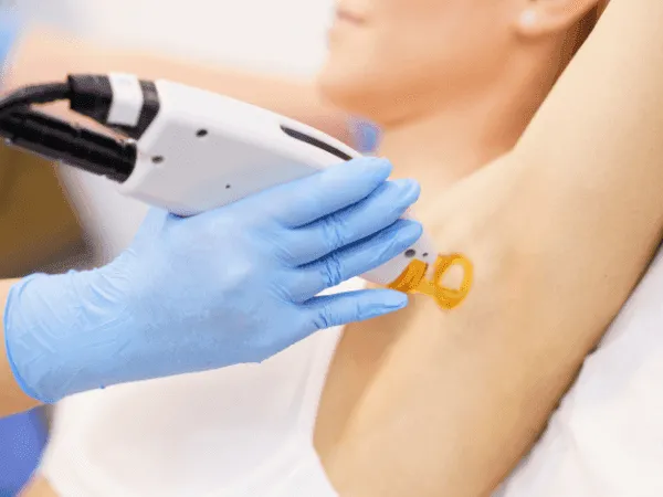 Epilazione laser diodo trattamento professionale