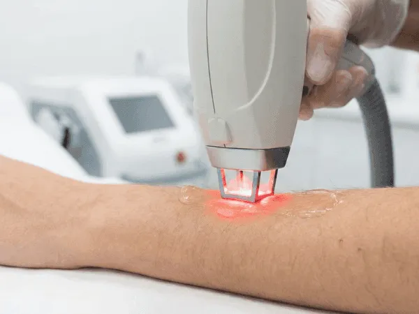 Trattamento di epilazione laser su braccio con tecnologia professionale