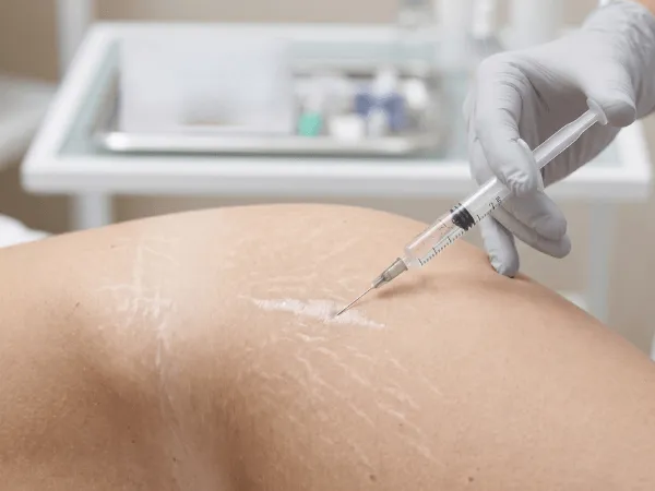 Iniezione filler acido ialuronico per riempimento smagliature