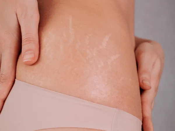 Dettaglio smagliature bianche cicatrizzate