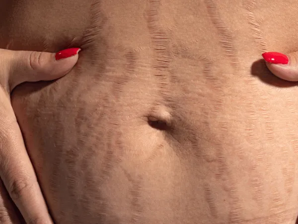 Dettaglio smagliature rosse in fase infiammatoria